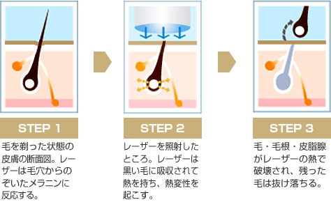 レーザー脱毛メカニズム