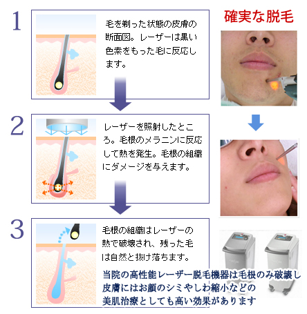 レーザー脱毛メカニズム