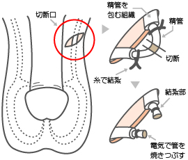 性欲 パイプ カット