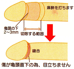 包茎亀頭直下法