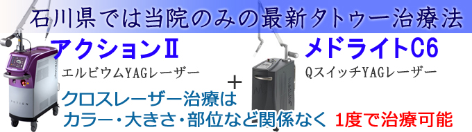 石川県では当院のみの最新タトゥー治療法